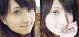 打美白针效果怎么样(美白针去哪里打)