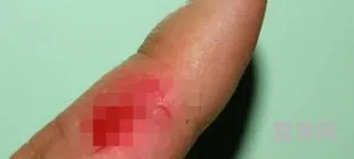 擦伤怎么处理(皮肤擦破皮了最快恢复方法不留疤)