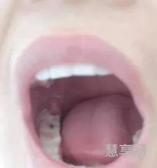 虫牙疼怎么办(虫牙补洞多少钱一颗)
