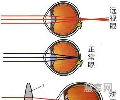 近视眼的形成原理(近视的产生)