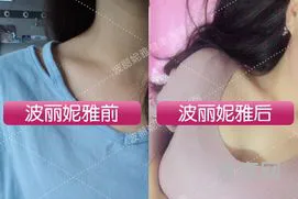 怎么能让胸变挺(什么办法能让胸变小吗)